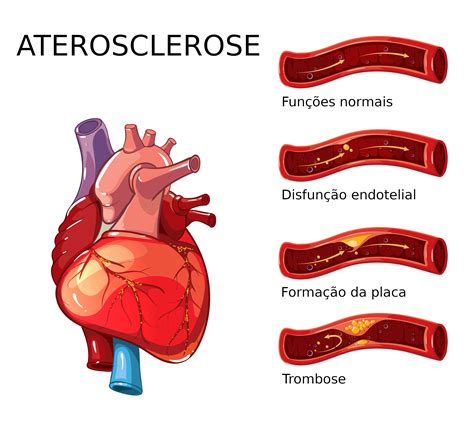 a aterosclerose é a causa principal de muitas doenças cardiovasculares